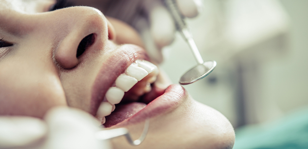 Porcelain Veneers